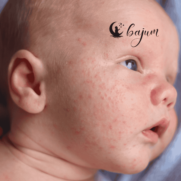 Co to jest trądzik niemowlęcy i jak wygląda? Objawy, przyczyny i leczenie trądziku noworodkowego