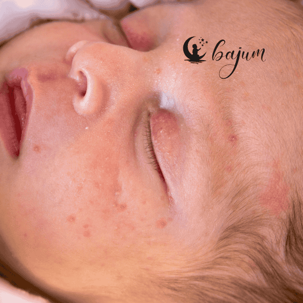 Trądzik niemowlęcy czy skaza białkowa? Jak odróżnić zmiany skórne u niemowlaka?