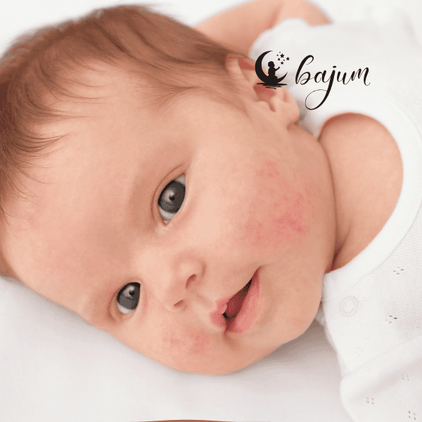 Wysypka na twarzy u niemowlaka – co oznacza? Sprawdź, co może być przyczyną krostek na policzkach dziecka