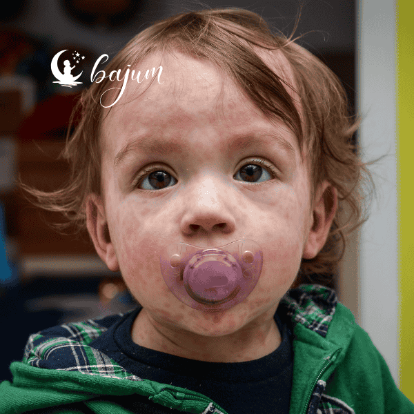 Co to jest rumień zakaźny u dzieci? Przyczyny, objawy i leczenie