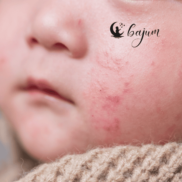 Co to są potówki u niemowlaka – jak je rozpoznać, leczyć i zapobiegać?